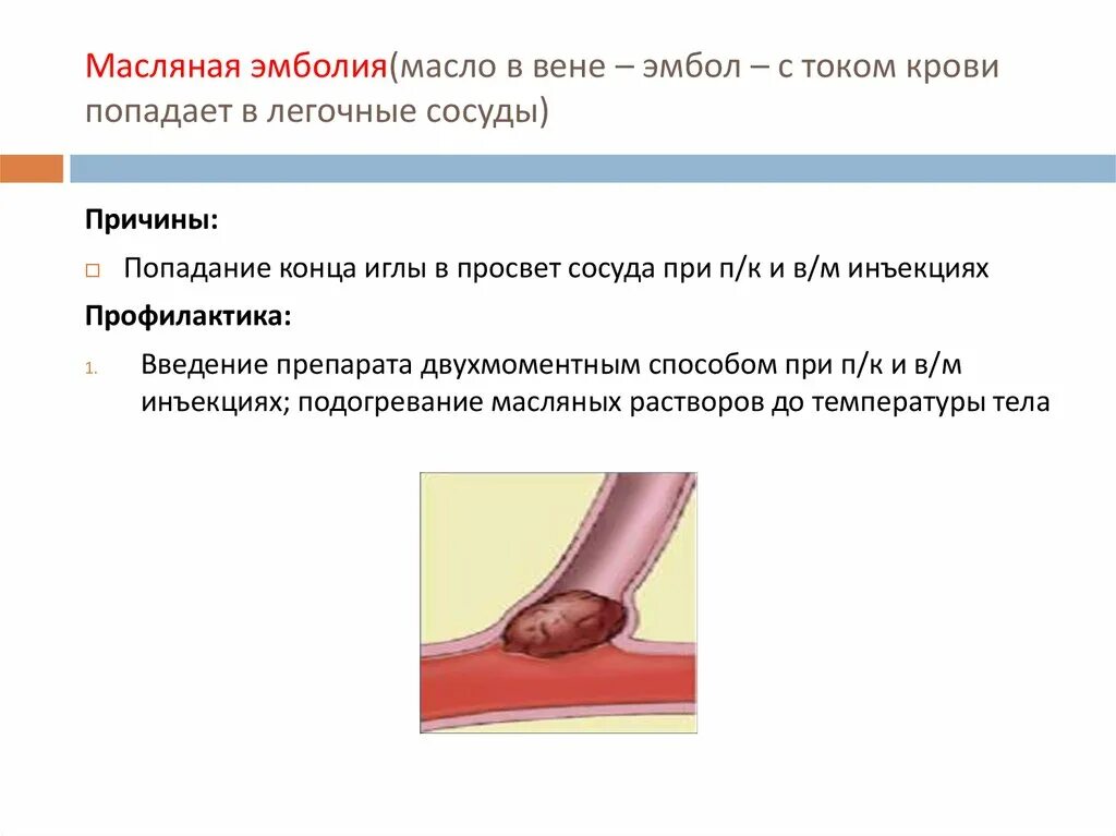 Кровь закупорка сосудов. Профилактика медикаментозной эмболии. Масляная эмболия причины профилактика. Медикаментозная эмболия. Медикаментозная эмболия симптомы.