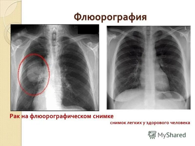 Снимок лёгких здорового. После флюорография можно можно кт делать