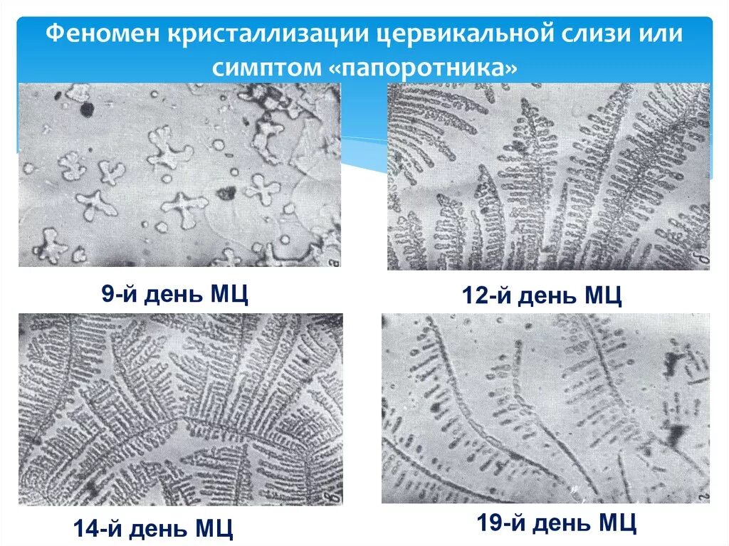 Слизистая при овуляции. Симптом кристаллизации цервикальной слизи (феномен «папоротника»). Исследование шеечной слизи симптом папоротника. Исследование цервикальной слизи симптом папоротника. Феномен кристаллизации шеечной слизи.