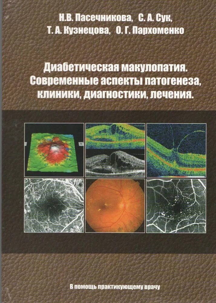 Диабетическая макулопатия глаза. Травматическая макулопатия. Миопическая макулопатия. Диффузная макулопатия. Макулопатия глаза