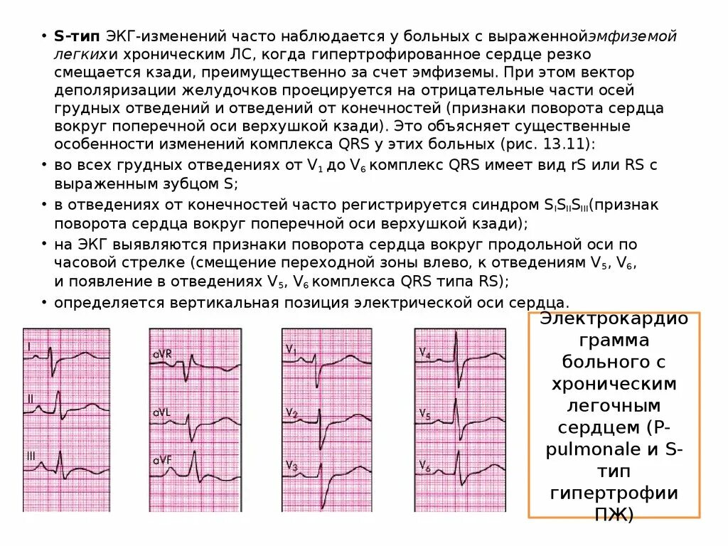 S Тип ЭКГ. S1 s2 s3 Тип ЭКГ. S Тип ЭОС на ЭКГ. S Тип гипертрофии правого желудочка на ЭКГ. Поворот правым желудочком вперед