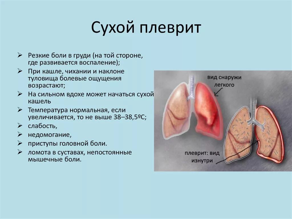 Сухой плеврит плевральная. Сухой плеврит при патологии. Воспалительный процесс при Сухом плеврите характеризуется. Сухой фибринозный плеврит. Плевральные осложнения