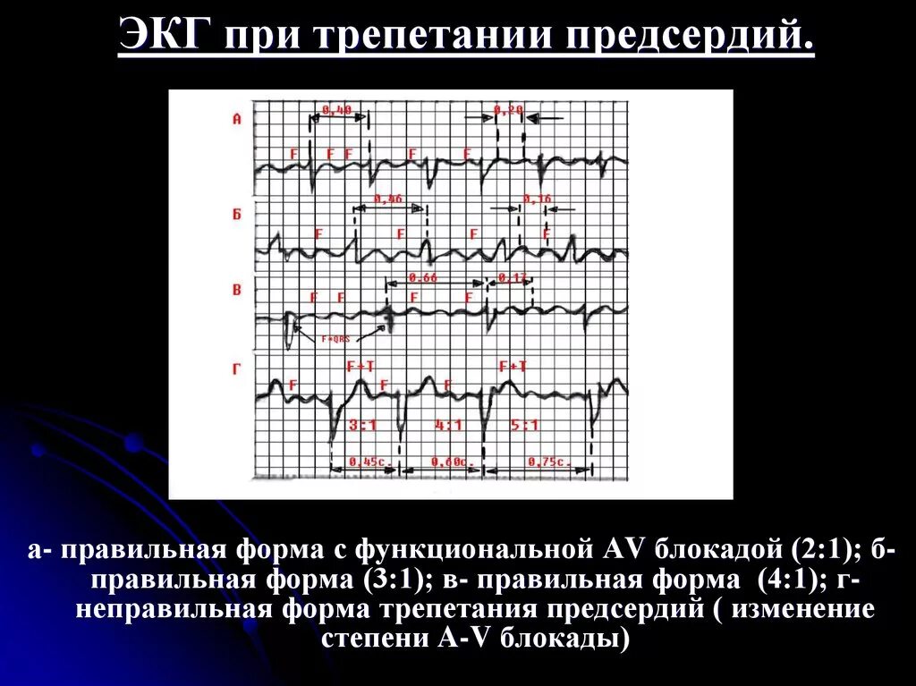 Трепетание предсердий 2 к 1 на ЭКГ. Трепетание предсердий 1 к 1 на ЭКГ. Трепетание предсердий на ЭКГ признаки. Трепетание предсердий неправильная форма на ЭКГ. Формы трепетания предсердий