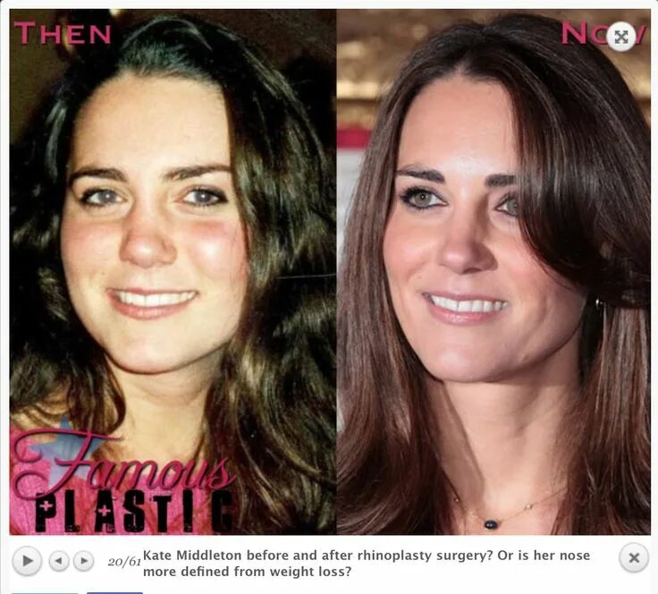 Kate Middleton Nose job, Rhinoplasty surgery, Plastic surgery