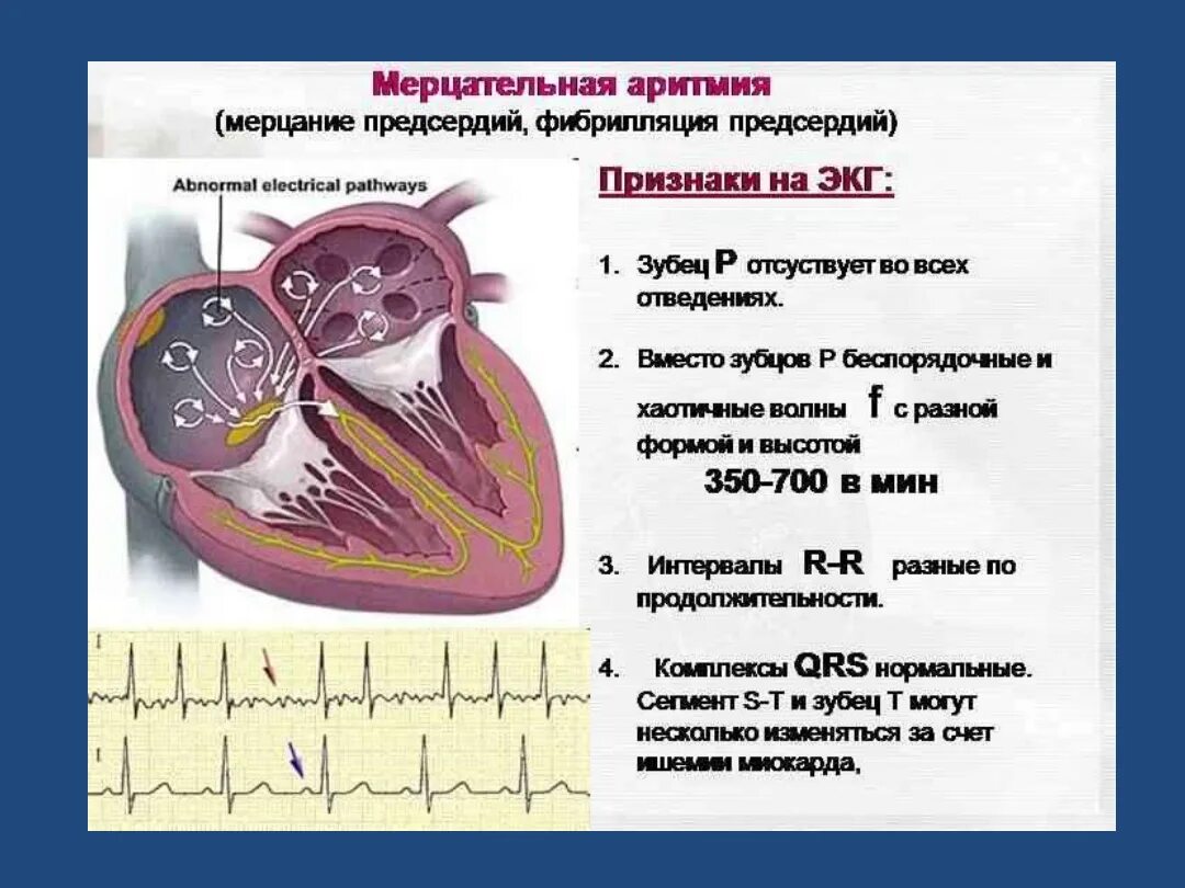 Как восстановить мерцательную аритмию