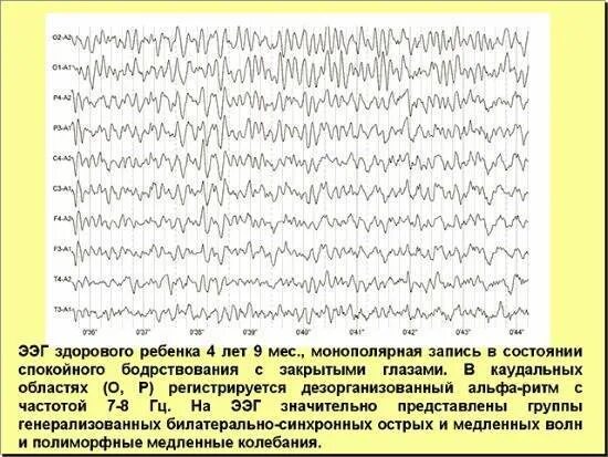 Голов показывать ээг. Электроэнцефалография (ээг) расшифровка. ээг головного мозга ритм альфа ритм норма. альфа ритм на ээг норма. ээг нормальные показатели у ребенка.