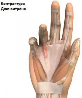 Дюпюитрена ладони