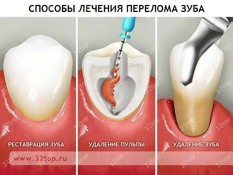 К чему снится зуб сломался без крови