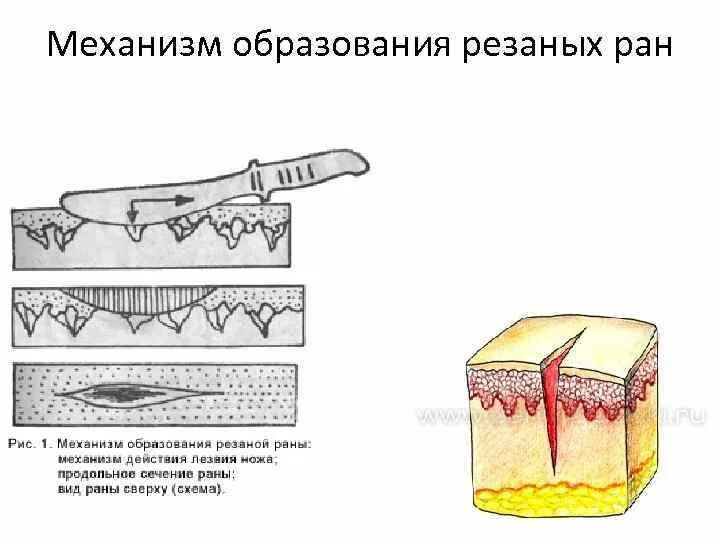 Механизм образования резаной раны. Колото резаные раны механизм образования. Механизм образования повреждения резаной раны. Колотые и колото резаные раны.