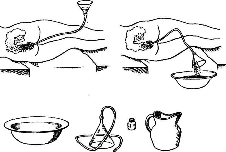 Постановка сифонной клизмы алгоритм. Сифонная клизма алгоритм. Промывание желудка сифонная клизма алгоритм. Постановка сифонной клизмы. Как правильно вставить кишку