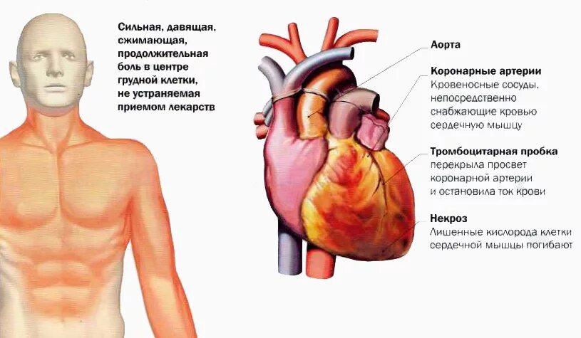 Сердечная мышца болит симптомы. Болит мышца в области сердца. Боль сердечной мышцы симптомы. Боль щемит