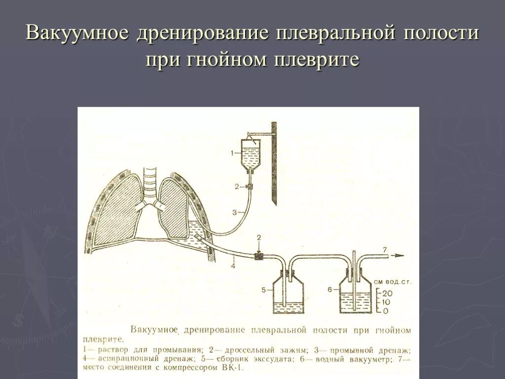 Лечение плевральной полости. Пневмоторакс дренирование плевральной. Пневмоторакс дренирование плевральной полости. Дренаж по Бюлау схема. Дренирование при пневмотораксе техника.