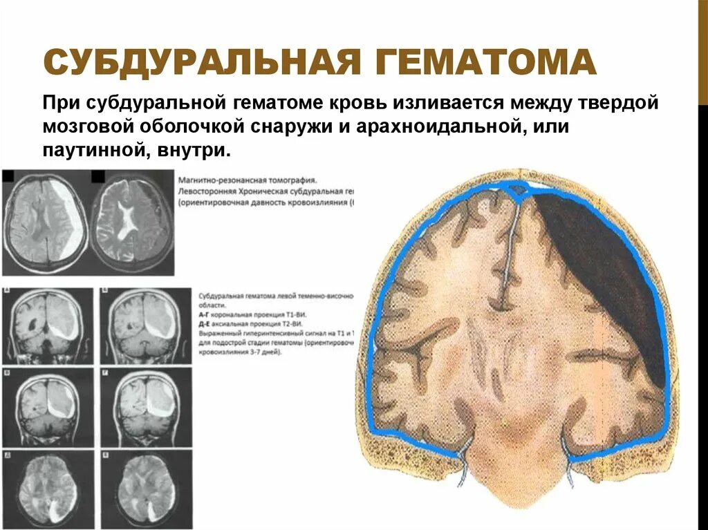 Пластинчатая субдуральная гематома. Субдуральная и эпидуральная гематома. Субдуральное кровоизлияние головного мозга на кт. Подострая субдуральная гематома на кт. Субдуральная гематома лечение