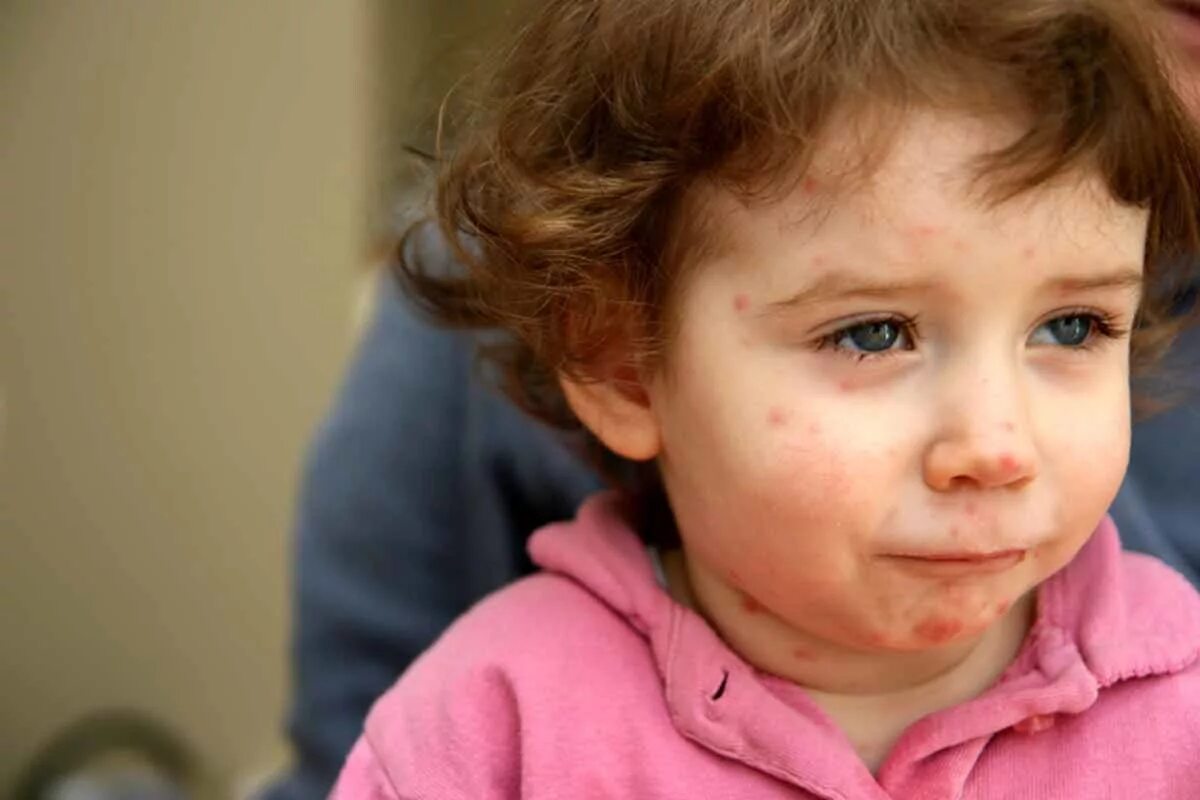 пищевая аллергия дети 4 лет