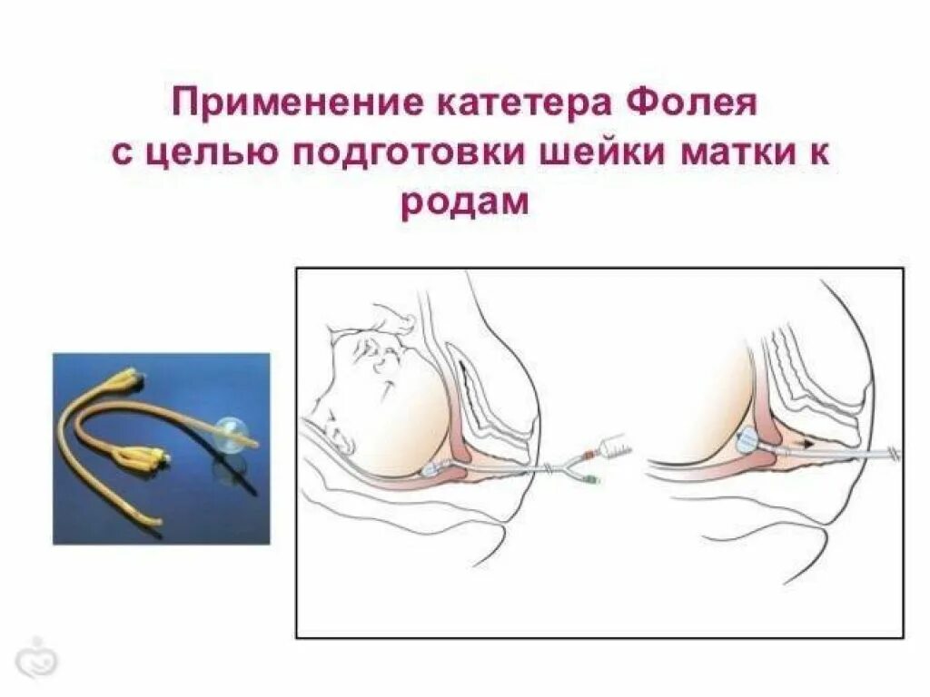 Катетер фолея для стимуляции родов. Балонный катетер для стимуляции родовой. Схватки после фолея. Схватки после фолея. Катетер для расширения шейки матки перед родами.