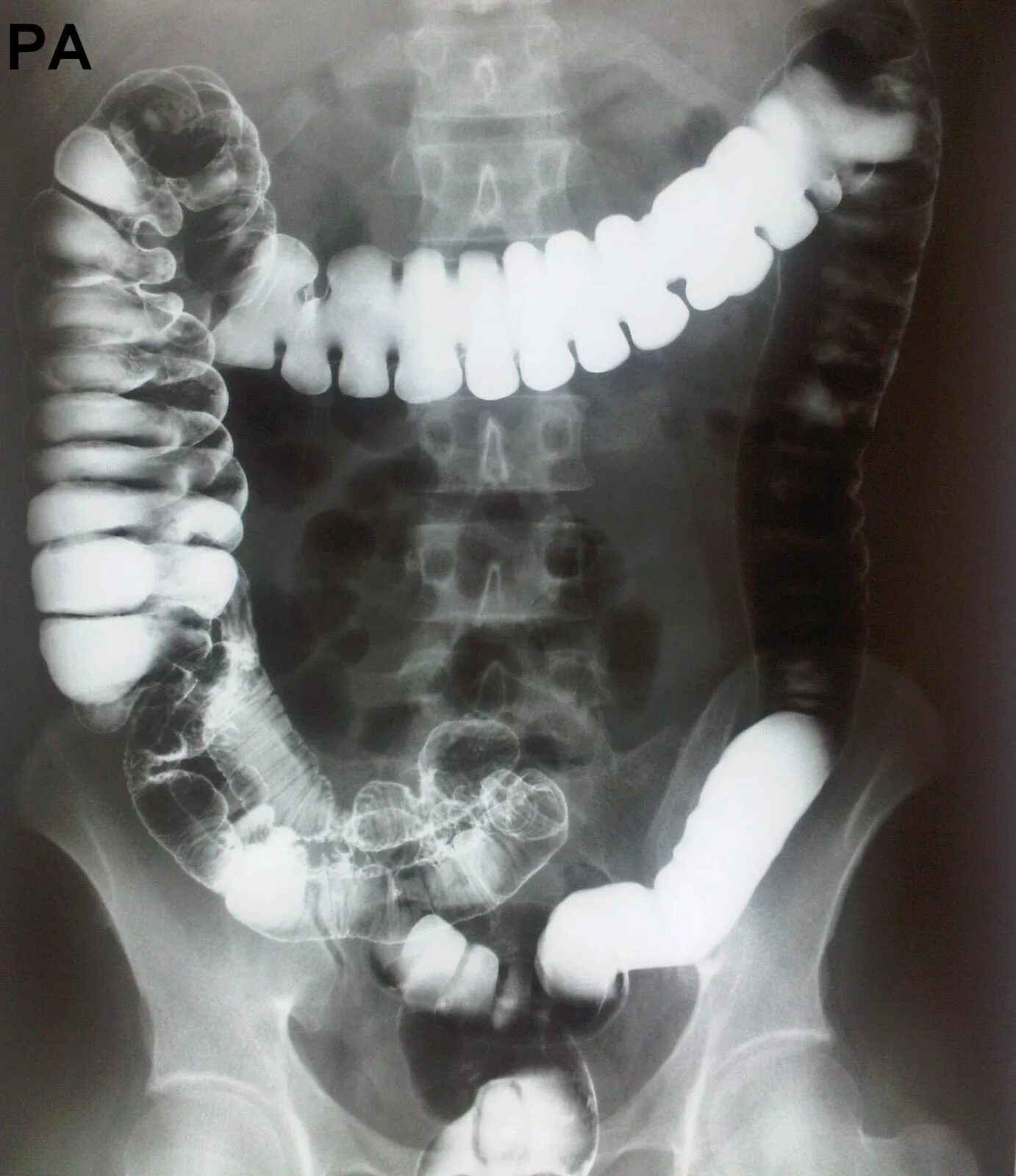 Appendix Pain Is Always an Emergency Cleveland clinic, Appendectomy recovery, Ap