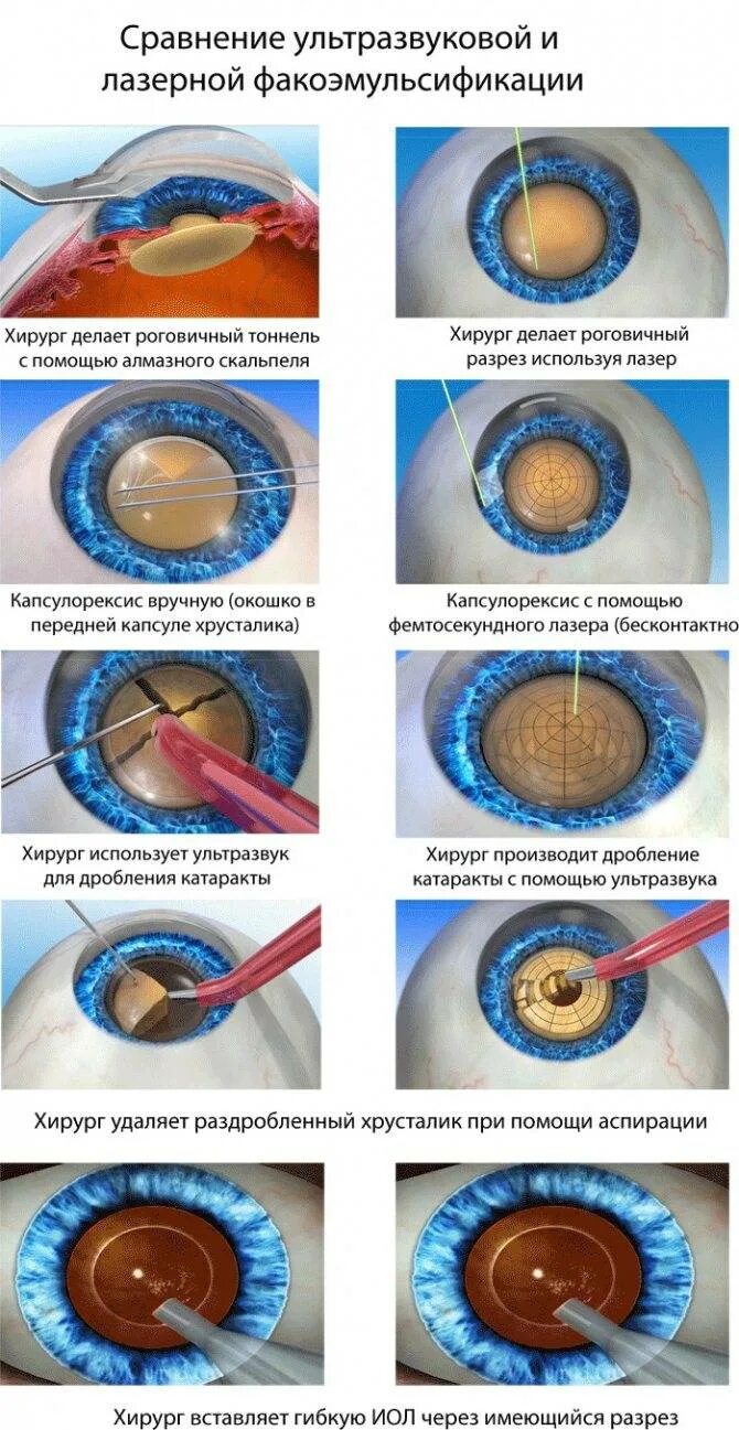 Операция факоэмульсификация катаракты. Факоэмульсификация катаракты этапы операции. Ультразвуковая факоэмульсификация катаракты этапы. Ультразвуковое хирургия катаракты - факоэмульсификация. Техника факоэмульсификации катаракты с имплантацией ИОЛ.