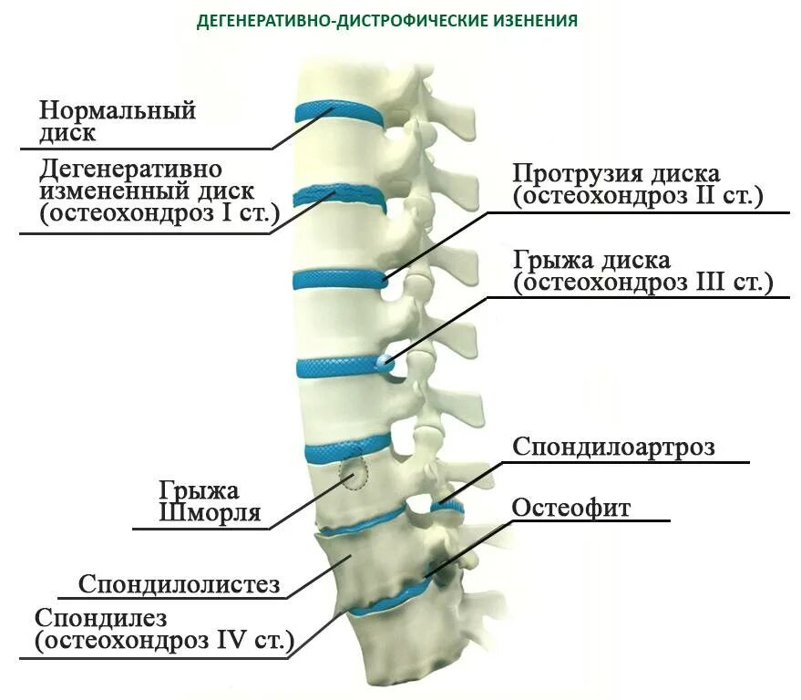 Протрузия межпозвоночного диска поясничного. Протрузии дисков c4/c5 c5/c6 c6/c7. Протрузия диска l1 l2, l2-l3. L2-l3 l3-l4 межпозвонковые диски. Протрузия диска th1/th2.