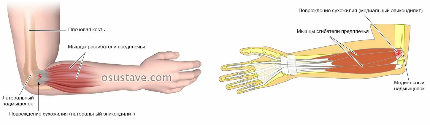 Локтевой сустав мышцы и сухожилия. Эпикондилит локтевого сустава. Медиальный эпикондилит сухожилия. Медиальный и латеральный эпикондилит. Латеральный или медиальный эпикондилит.
