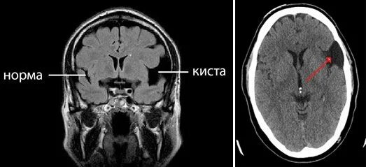 Киста в лобной доле. Арахноидальная киста лобной области мрт. Ликворная киста головного мозга мрт. Ретроцеребеллярная ликворная киста мрт. Ретроцеребеллярная арахноидальная киста мрт.