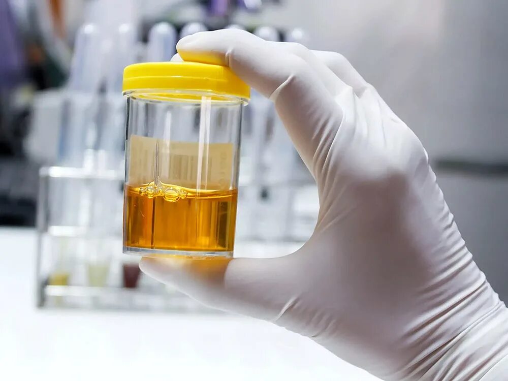 забор материала для микробиологических исследований. лаборатория посев мочи. исследование мочи. лаборатория посев мочи. чашки петри бактериология.