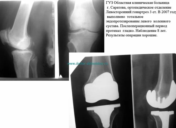 Дают инвалидность после замены сустава. Тотальный эндопротез коленного сустава. гонартроз эндопротезирование коленного сустава. эндопротез коленного сустава рентген. артроз коленного сустава эндопротез.