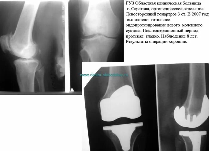 Тотальный эндопротез коленного сустава. Гонартроз эндопротезирование коленного сустава. Артроз коленного сустава эндопротез. Эндопротез коленного сустава рентгенограмма. Инвалидность после эндопротезирования