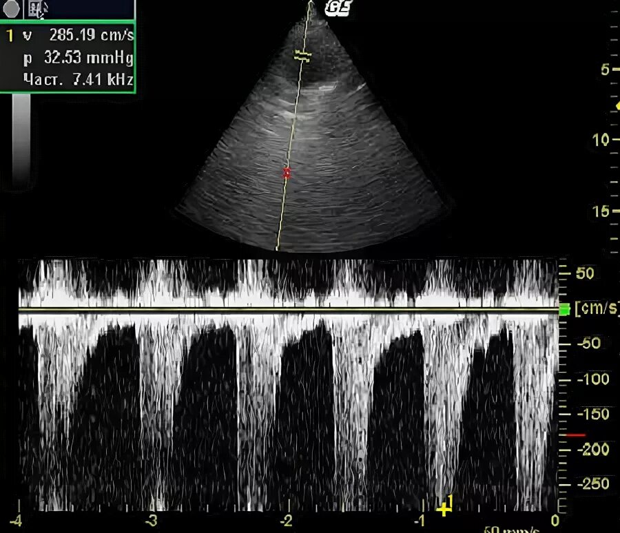 Вентиляционно перфузионное соотношение. Градиент давления на аортальном клапане норма. Легочный градиент. Градиентный фон для фотошопа. Эхо кг давление в легочной артерии норма.