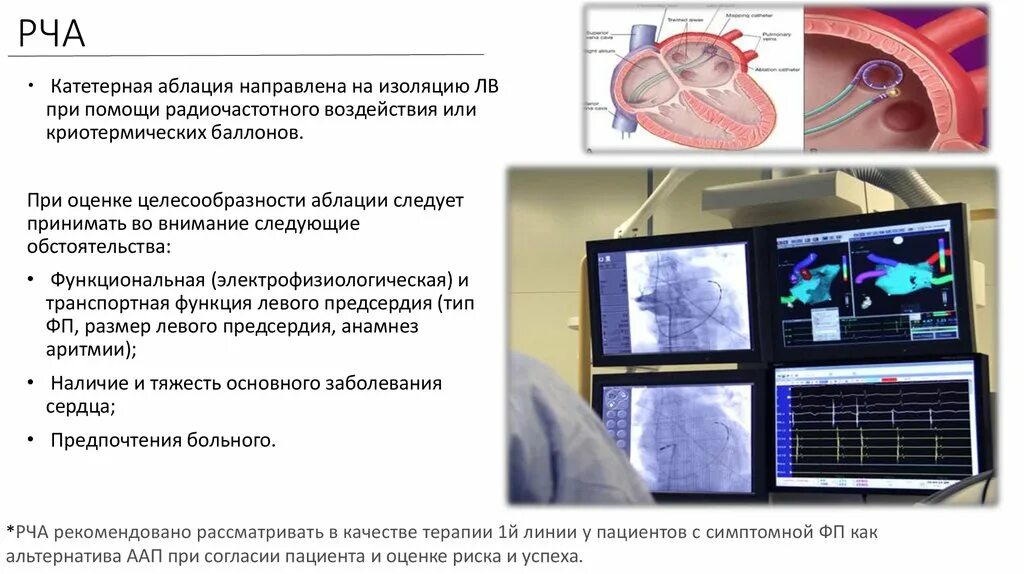 Радиочастотная абляция фибрилляции предсердий. РЧА устьев легочных вен при фибрилляции предсердий. РЧА методика проведения. Радиочастотная абляция при фибрилляции предсердий.