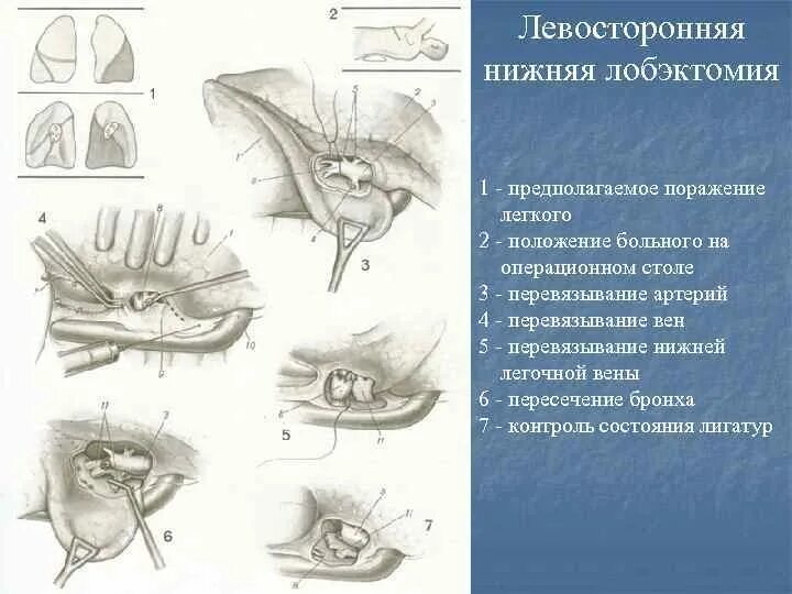 Операция левого легкого. Лобэктомия легкого операция техника. Лобэктомия ход операции. Верхняя лобэктомия операция. Лобэктомия и пневмонэктомия.