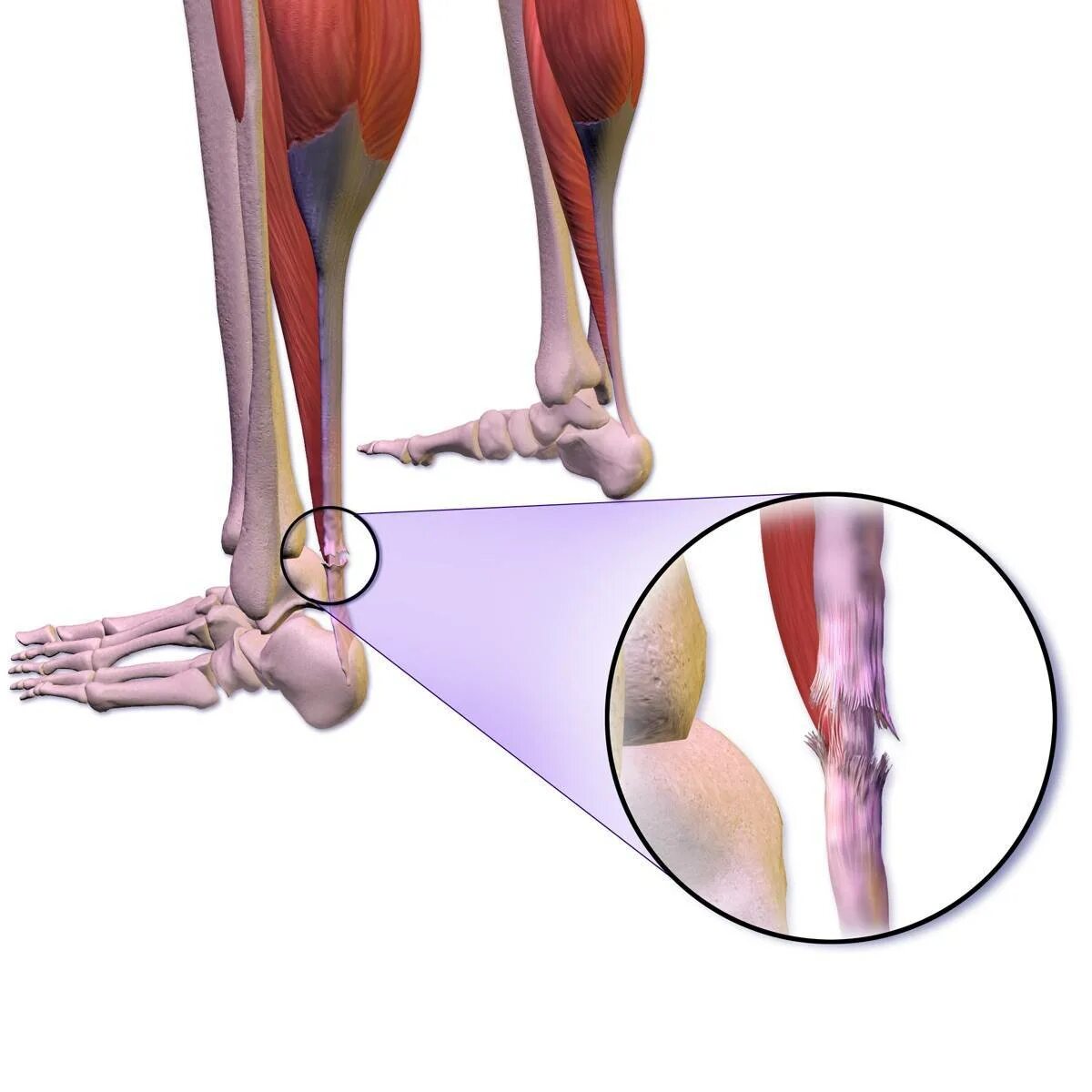 Порванные связки ахиллова сухожилия. Разрыв ахиллова сухожилия. Растяжение ахиллова сухожилия (тендинит). Разрыв связок ахиллова сухожилия симптомы. Взять разрыв