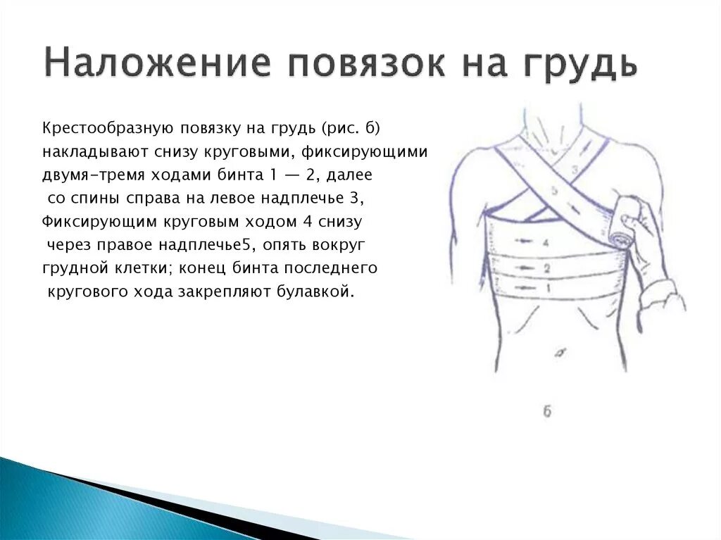 Повязка на молочные железы алгоритм. Наложение повязки на грудную клетку алгоритм. Крестообразная повязка на грудную клетку алгоритм наложения. Крестообразная повязка на грудь. Наложение крестообразной повязки на грудь.