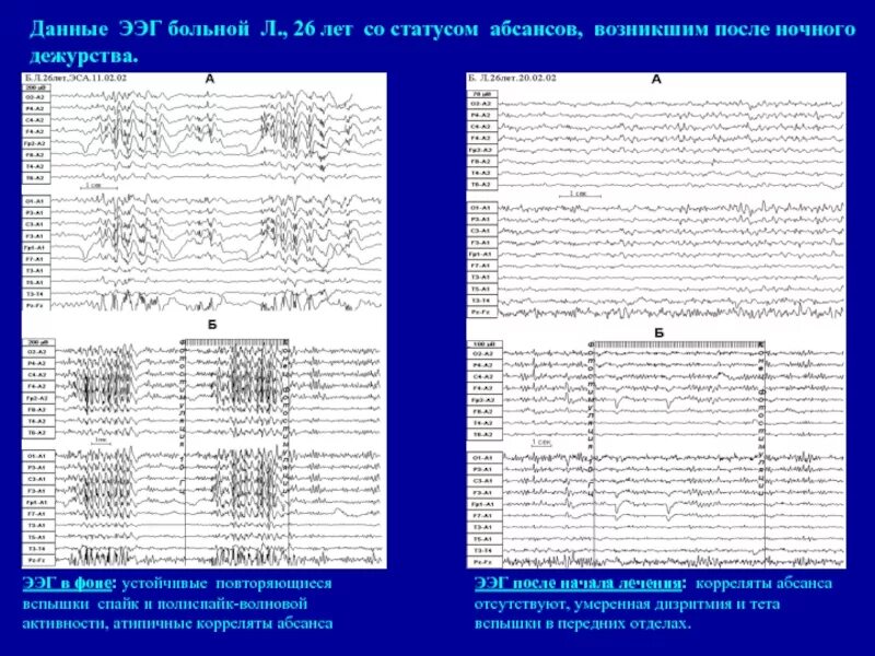 Абсанс эпилепсия ЭЭГ. Типичный абсанс на ЭЭГ. Паттерн абсанса на ЭЭГ. Абсансная активность на ЭЭГ. Спайк на ээг