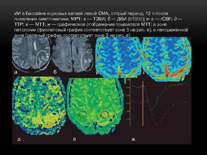 ОНМК В бассейне левой средней мозговой. ОНМК В бассейне СМА. Ишемический инсульт в бассейне левой средней мозговой артерии. ОНМК В бассейне левой СМА.