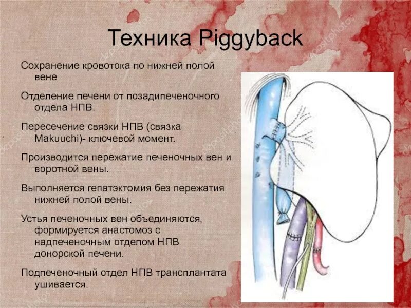 Техника Piggyback трансплантация печени. Связка нижней полой вены. Техника Piggyback.