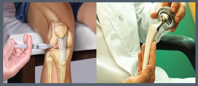 Эндопротезирование коленного сустава. Искусственный коленный сустав. Операция по эндопротезированию коленного сустава. Менять коленный сустав операция. Форум операции по замене суставов