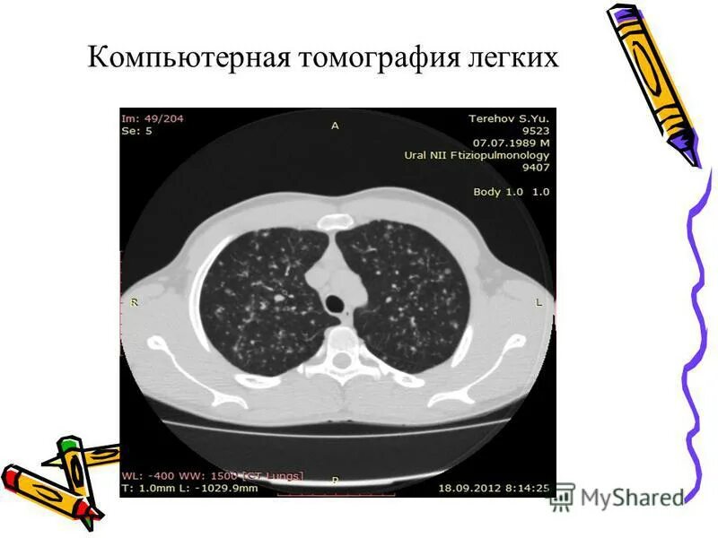 Кт легких долгопрудный. Здоровые легкие на кт. Компьютерная томография легких. Кт легких долгопрудный. Кт легких долгопрудный.
