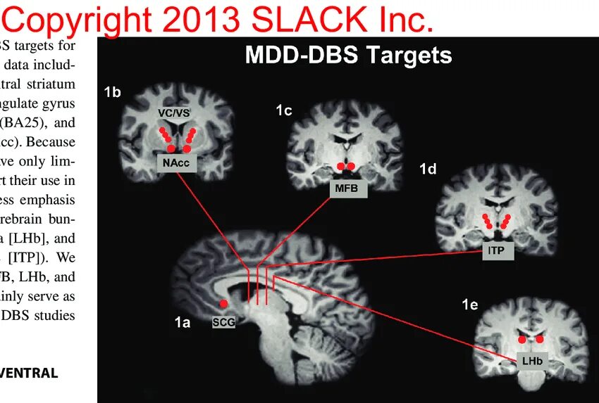 Deep brain. Mer Deep Brain stimulation. «Стимуляция глубинных структур головного мозга» (Deep Brain stimulation, DBS).. Stimulates the Brain РВ.