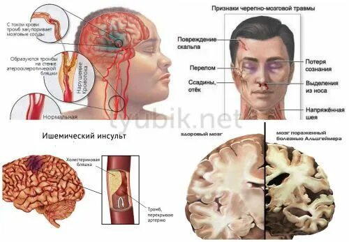 Черепно-мозговая травма клиника. Черепно мозговая травма инсульт. Ишемический инсульт головного мозга клиника. Головной мозг после инсульта.