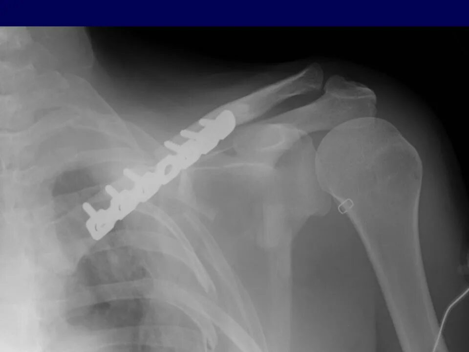 Перелом ключицы рентген. Сколько срастается ключица. Оскольчатый перелом ключицы. Аддукционный перелом ключицы. Сколько срастается ключица.