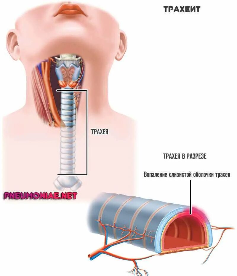 Трахеи трахеит симптомы. Болезнь трахея трахея кашель. Воспалительные заболевания трахеи. Воспаление гортани и трахеи.