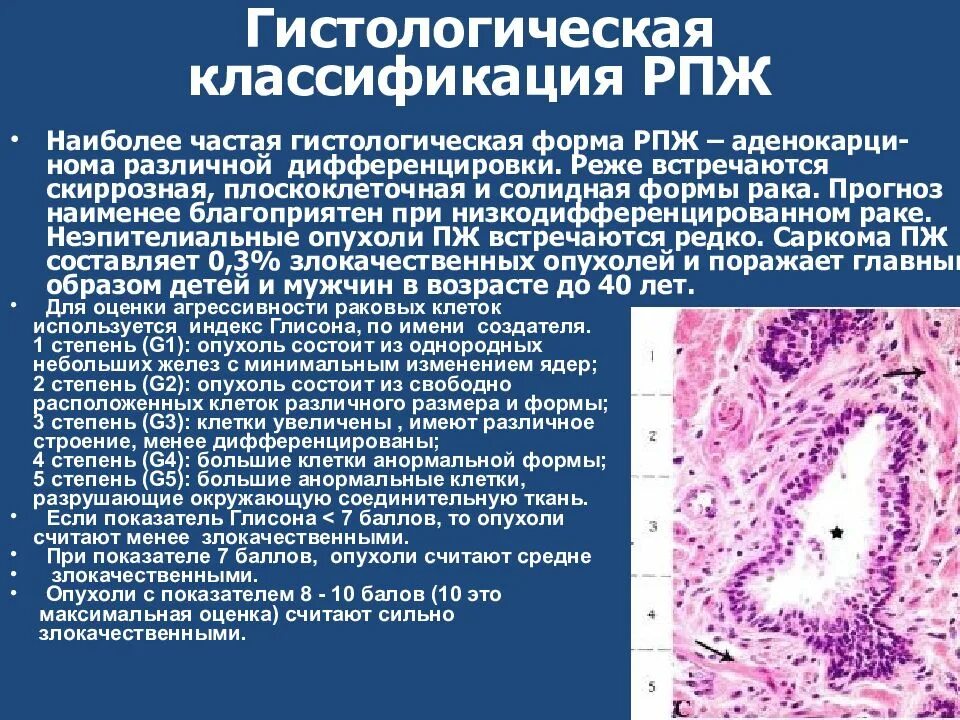 Гистологическая классификация опухолей предстательной железы. Классификация РПЖ. Опухоли предстательной железы лекция. Классифткациярака предстательной.