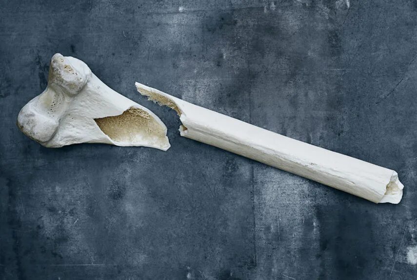 Перелом диафиза лучевой кости рентген. Break bone. Break bone. Broken bone png. Кость нарисованная.