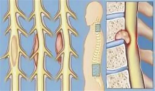 Экстрадуральные опухоли спинного мозга. Интрамедуллярные опухоли спинного мозга. Образование позвоночника. Интрадуральные опухоли спинного мозга. Интрамедуллярные опухоли спинного