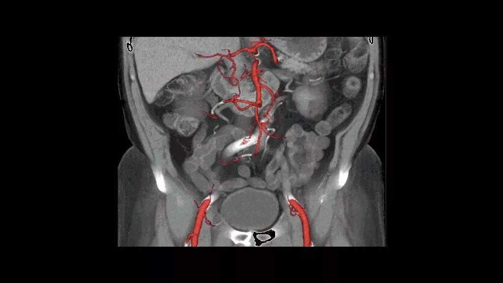 Кт ангиография чревного ствола. Кт ангиография брюшной полости. Стеноз чревного ствола на кт. Аорта брюшной полости операция