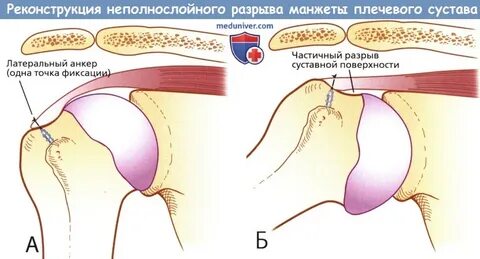 Повреждение манжеты