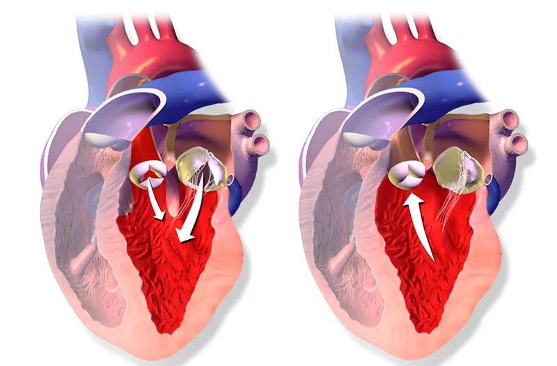 Митральный аортальный стеноз. Порок сердца стеноз аортального клапана. Стеноз аортального клапана клапан. Стеноз и недостаточность аортального клапана. Стеноз двустворчатого аортального клапана.