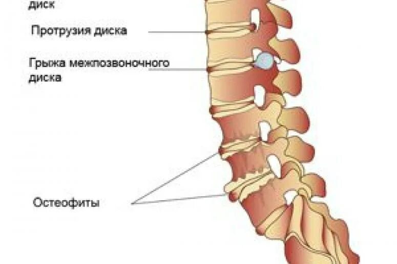 Спинные диски. Диск позвонка. Протрузия позвоночника. Протрузия дисков позвоночника что это такое. Протрузия грыжа остеофиты.