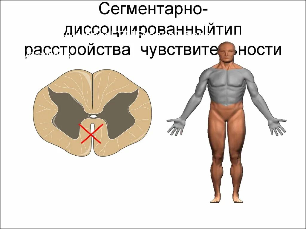 Сегментарный тип расстройства. Сегментарно диссоциированное расстройство чувствительности. сегментарный диссоциированный тип расстройства чувствительности. сегментарный тип нарушения.