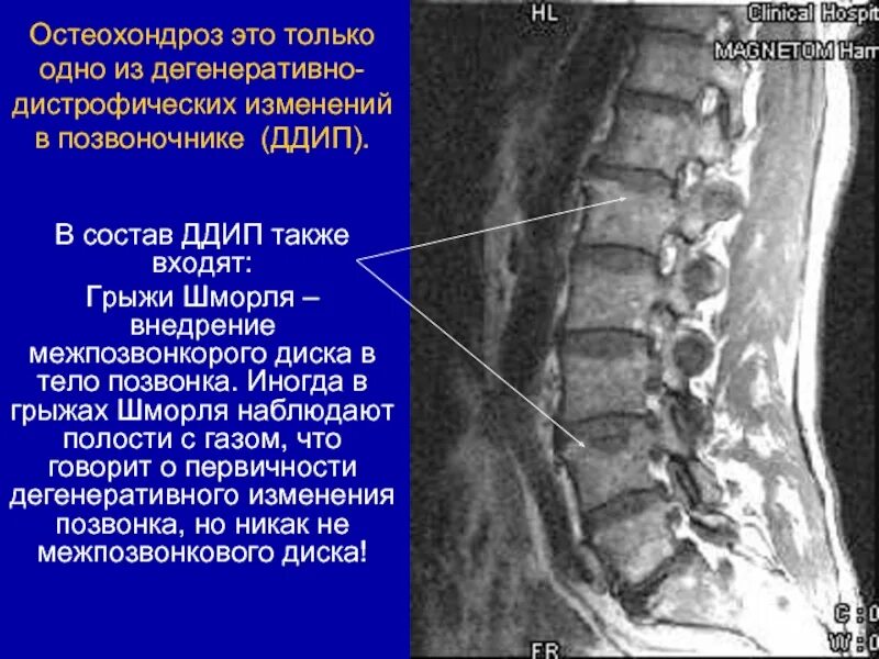 Дистрофические изменения позвоночника. Дегенеративно-дистрофические изменения позвоночника. Дегенеративные изменения позвонка. Дистрофические изменения позвонков. Дегенеративные изменения тел позвонков.